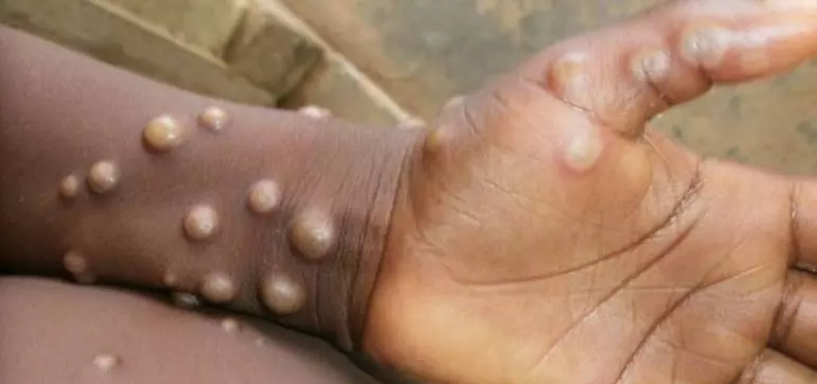 Anvisa sugere uso de máscara e distanciamento para evitar chegada de varíola