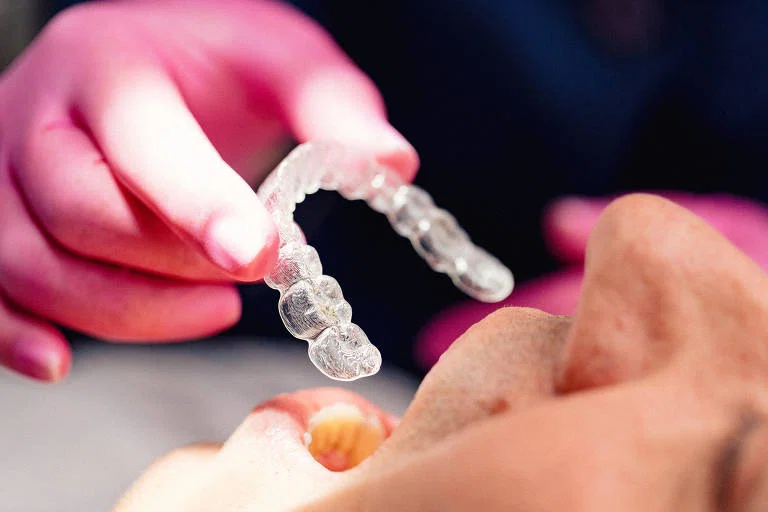 Alinhadores estéticos: dentista explica sobre novo método ortodôntico 