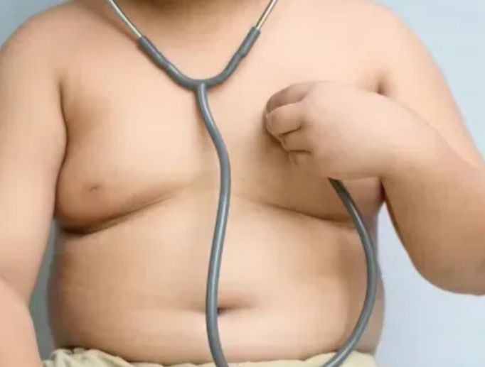 Obesidade é considerada doença crônica e problema de saúde pública
