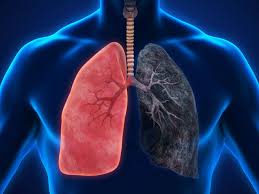 Falta de ar, tosse e chiado: saiba identificar sinais da DPOC, terceira causa de morte no mundo