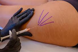 “Segredo das famosas”: harmonização glútea vai além da estética e resgata autoestima das mulheres